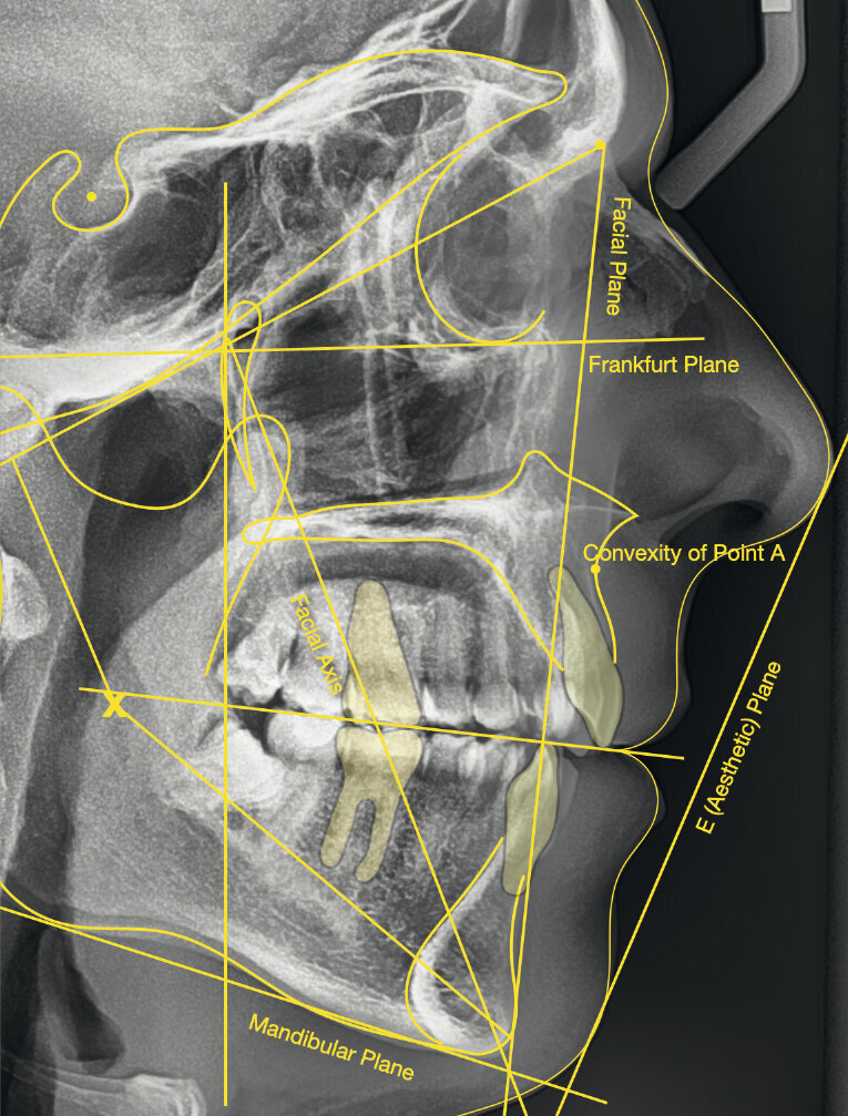 Fig. 9_Radiografia cefalometrica laterale pre-trattamento.