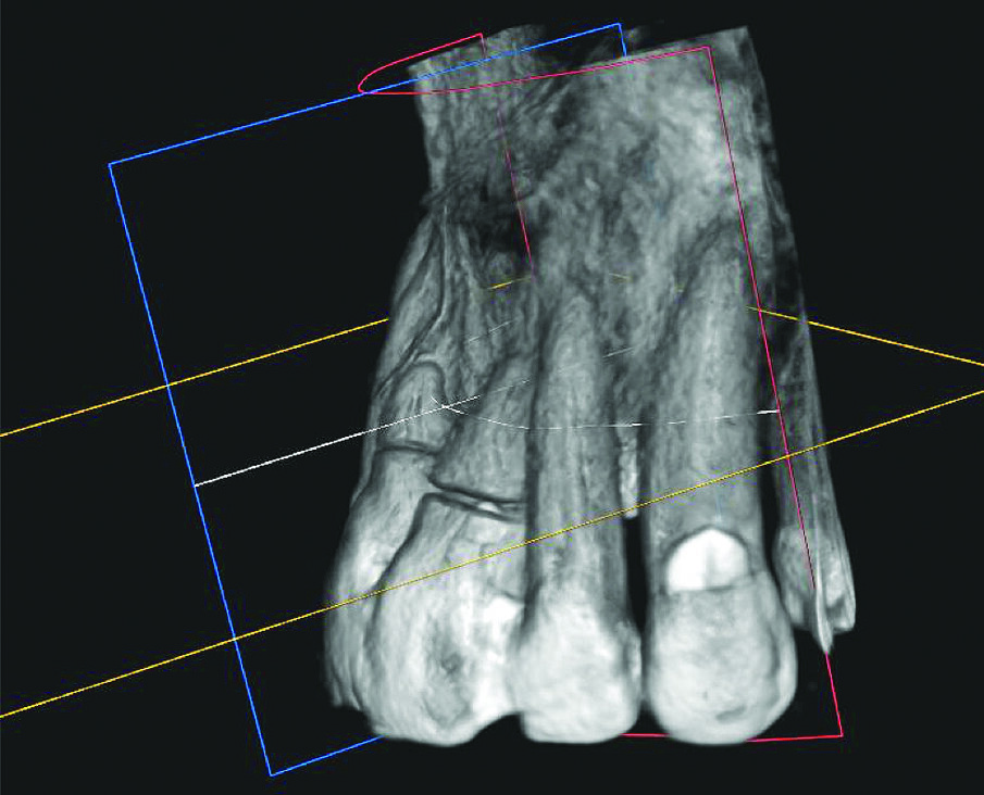Slika 6. CBCT prije implantacije: vrlo tanka bukalna koštana lamela i bliski odnos korijena s korteksom