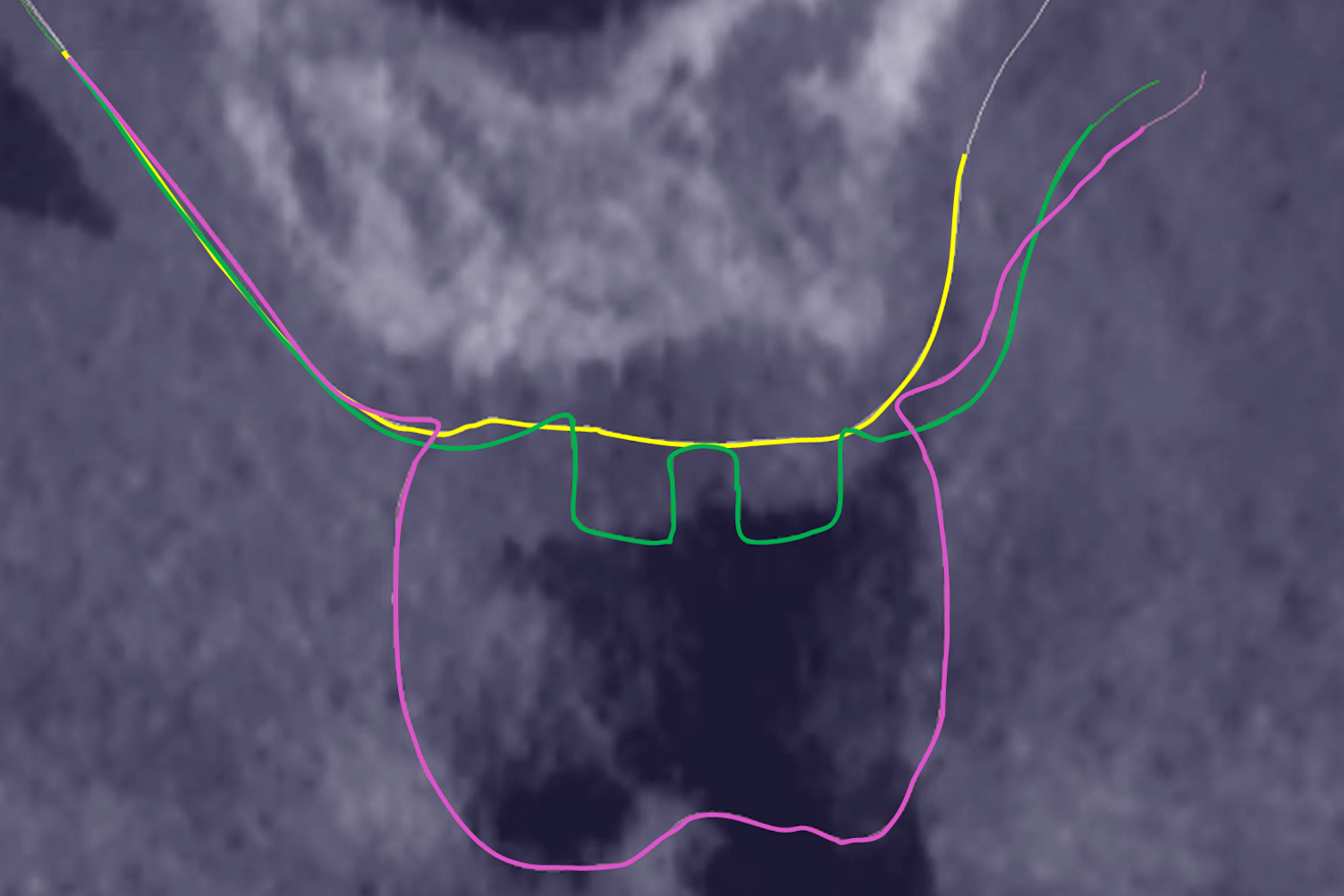 Fig. 3: Standard superimposition of the intra-oral scans taken before surgery (yellow line), at soft-tissue healing (green line) and at prosthesis delivery (purple line) on the pre-op CBCT scan (the right side is the buccal side).