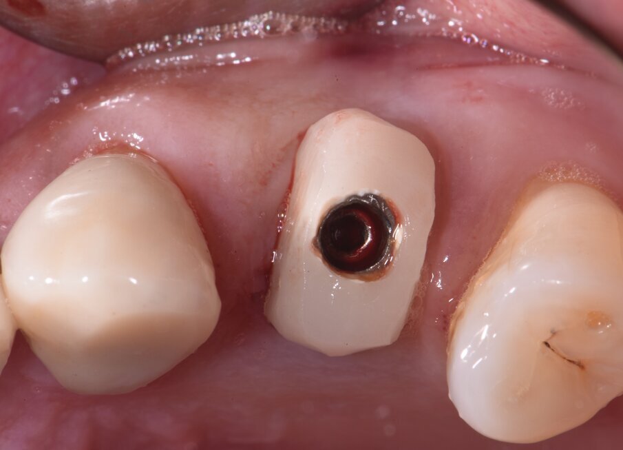 Fig. 2 - Coppetta di guarigione castomizzata avvitata sull’impianto appena inserito nell’alveolo post-estrattivo.