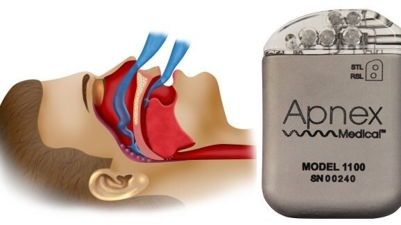 Un neurostimulateur semblable à un stimulateur cardiaque, pour éviter l'apnée du sommeil