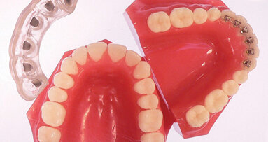 Simpli5: the next generation in invisible orthodontic therapy