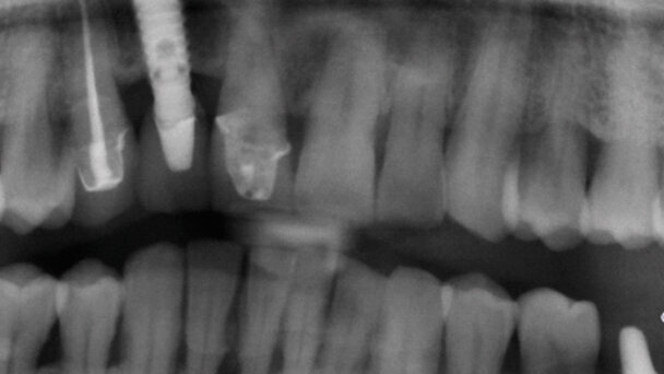 Impianti a connessione conometrica: semplificazione protesica in zona anteriore