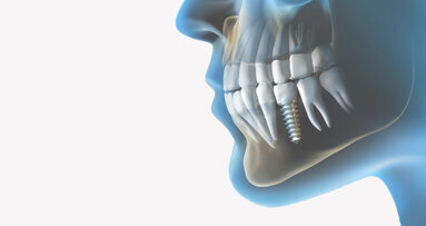Предстои теоретично-практически курс за работа с имплантната система Alpha Bio Tec