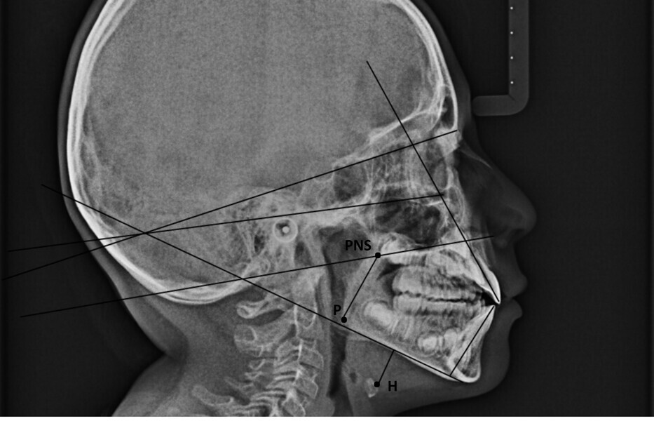 Fig. 15a: Comparison of the cephalometric radiograph and functional tracing at the (a) start and (b) end of treatment. PNS = posterior nasal spine; H = hyoid bone; P = tip of the soft palate.