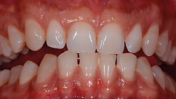 Il protocollo tailoring di sbiancamento. Per un feedback endo valutativo di un odontoiatra testimonial delle sue terapie cosmetiche. Case report