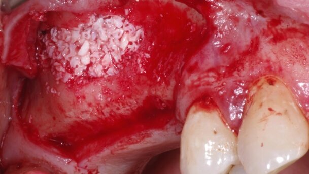 Podstawowe zasady zespalania tkanek miękkich  i wybór materiałów szewnych w chirurgii jamy ustnej