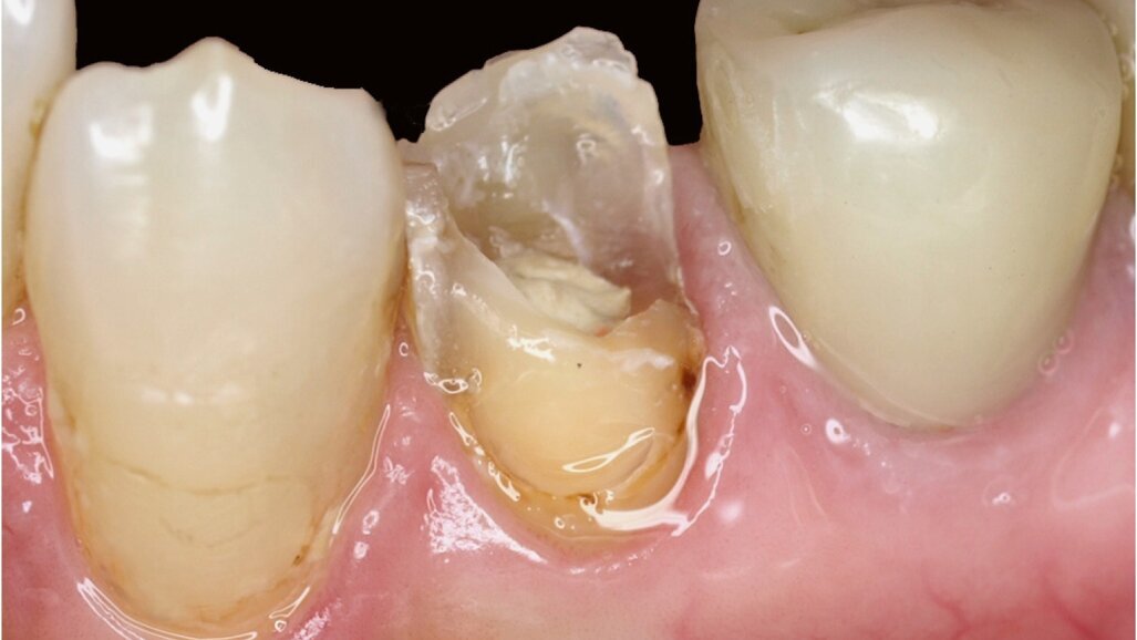 Fijación de espigas y reconstrucción de muñón en una sesión