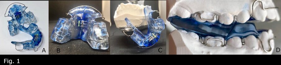 Fig. 1 - Placche Twin-Block (A); Placca superiore (B); Placca inferiore (C); Placche in occlusione (D).