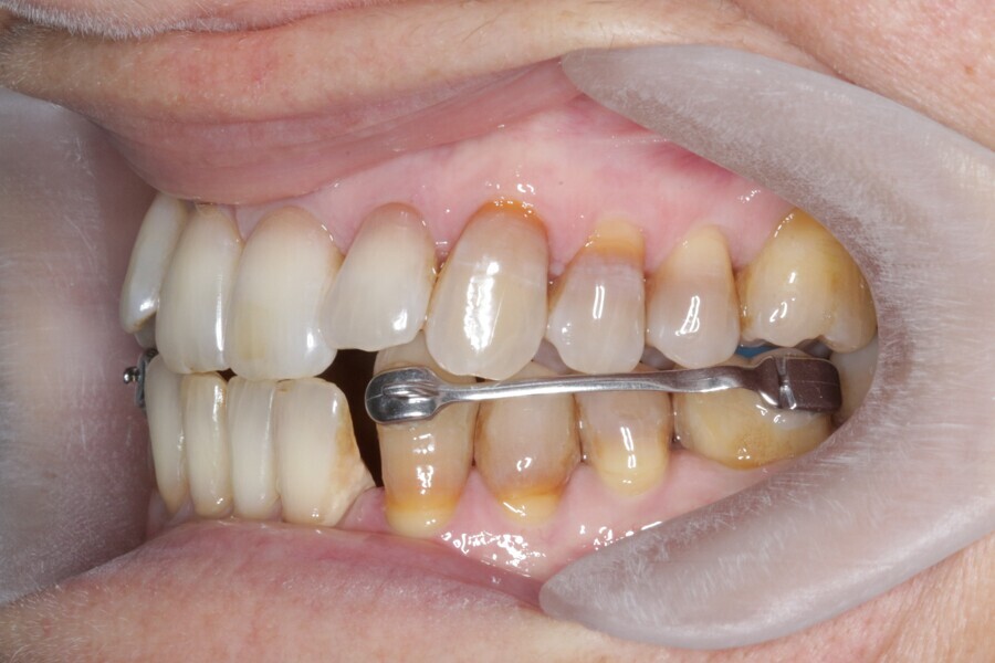 Fig. 32: Placement of the Carriere Motion 3D Class III appliance.