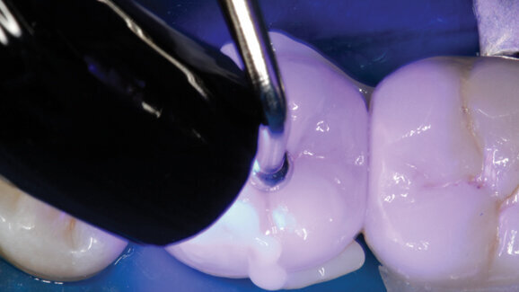 Cementation of restorations: A new luting composite