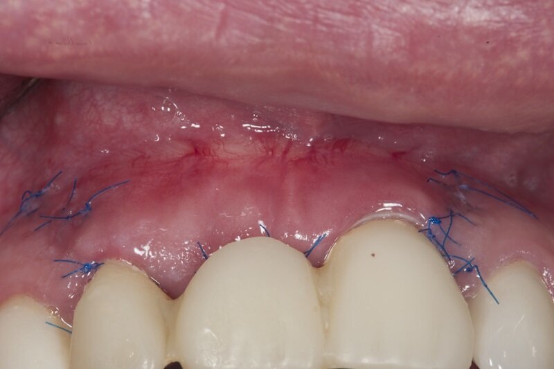 Ryc. 13_Stan 3 tygodnie po zabiegu regeneracyjnym.