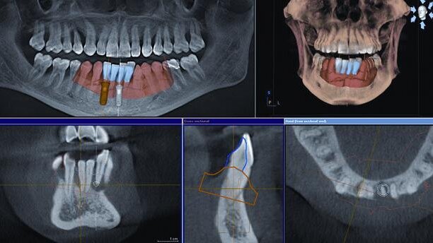 CBCT-assisted implant therapy: A case study