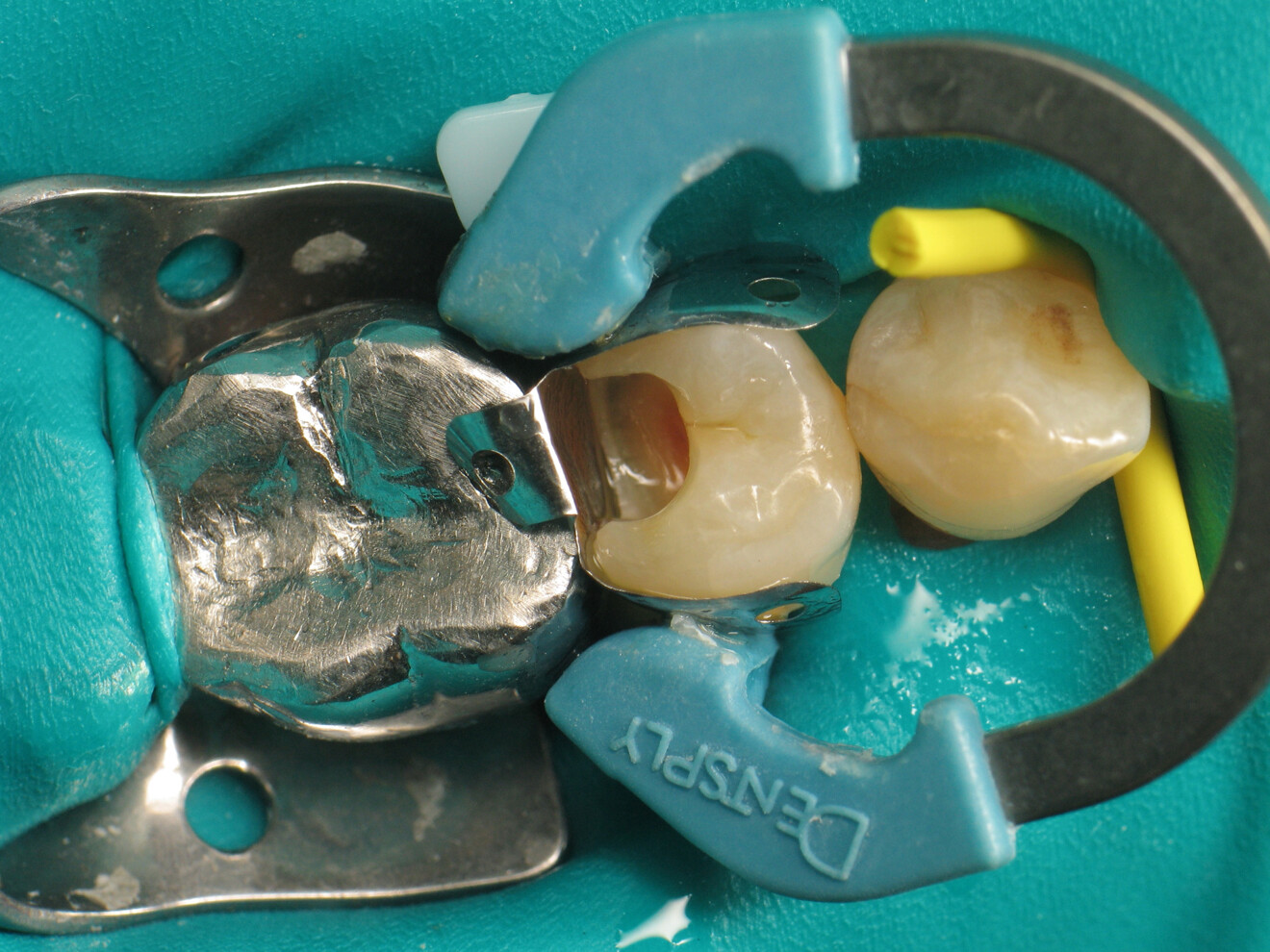 Fig. 8: Cavity after application of Futurabond DC.