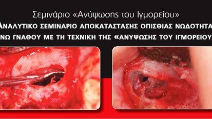 Σεμινάριο ανύψωσης του ιγμορείου