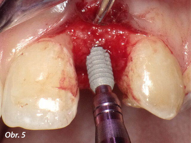 Do rozšířené osteotomie byl zaveden implantát o průměru 3 mm. Všimněte si designu drážek a zkosení u krčku.