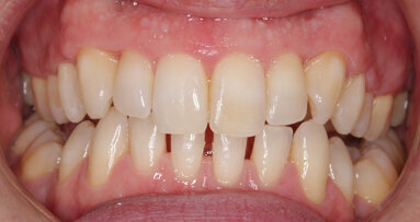 Getting to grips with general dental practitioner orthodontics