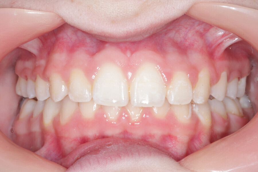Fig. 5: Initial situation. Class II malocclusion patient.