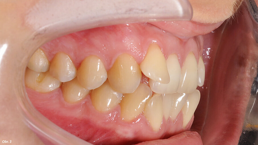 EIntraorální fotografie počátečního stavu pacientky.