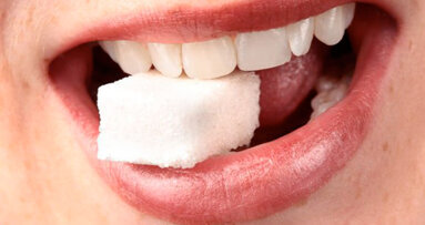 La malattia orale indotta da zucchero è la più onerosa per il sistema sanitario tedesco