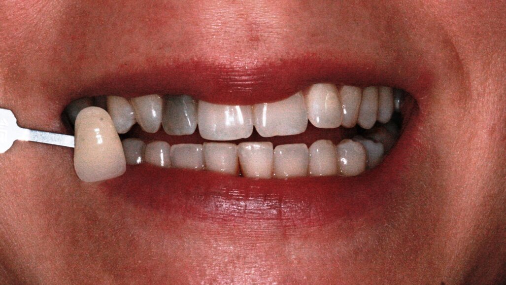 Caso clinico di sbiancamento interno ed esterno