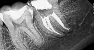 PHAST PIPS: The photoacoustic wave of the future?