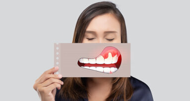 KZBV: Über 30 Millionen Deutsche sind an Parodontitis erkrankt