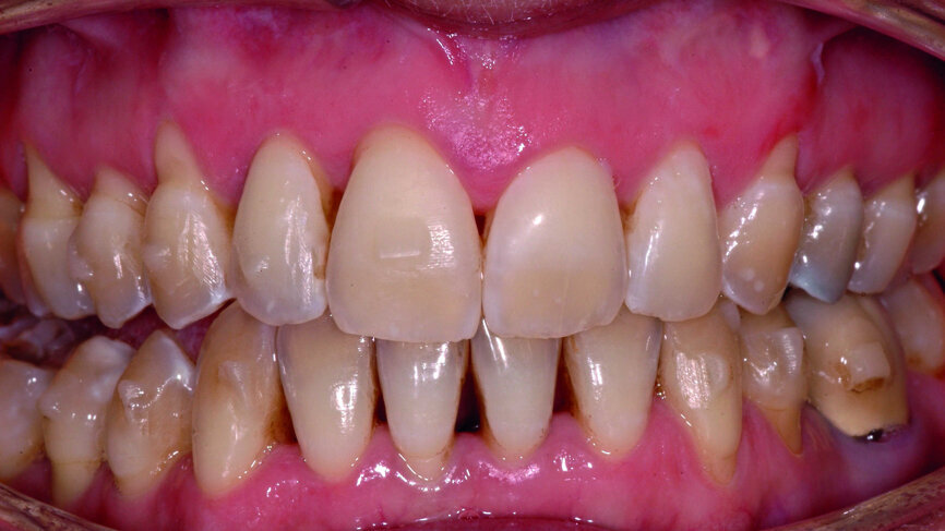 Fig. 3a : Vue latérale post aligneur