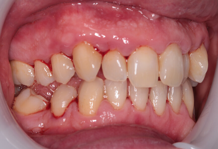 Fig. 9: Post-scaling left lateral view