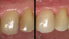 Restauraciones de clase III y IV con composite termoviscoso