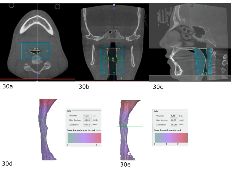 Figs. 30a–e: (a–c) Post-treatment airway volume. Comparison between the (d) pretreatment and (e) post-treatment volume obtained from the CBCT scan.