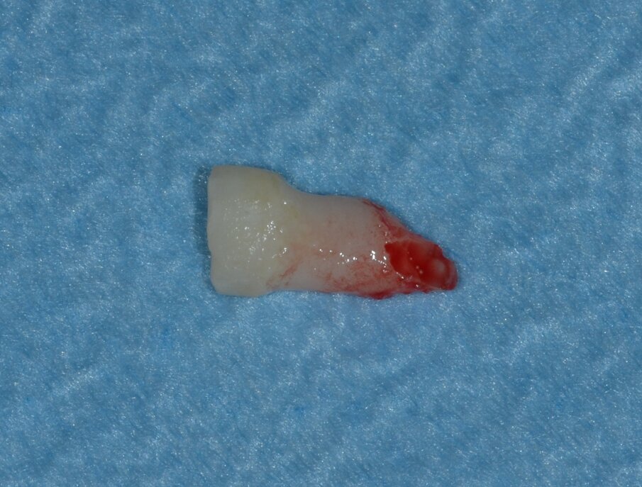 Fig. 5_Estrazione dell’elemento deciduo 5.1.