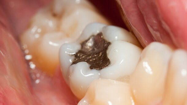 Nederlandse ‘horrortandarts’ ruïneerde Franse gebitten