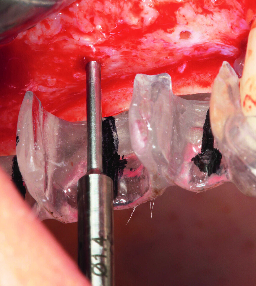 Fig. 6 : Détermination de la position des implants.