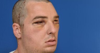 Dental, facial reconstructive surgeons perform most extensive full-face transplant