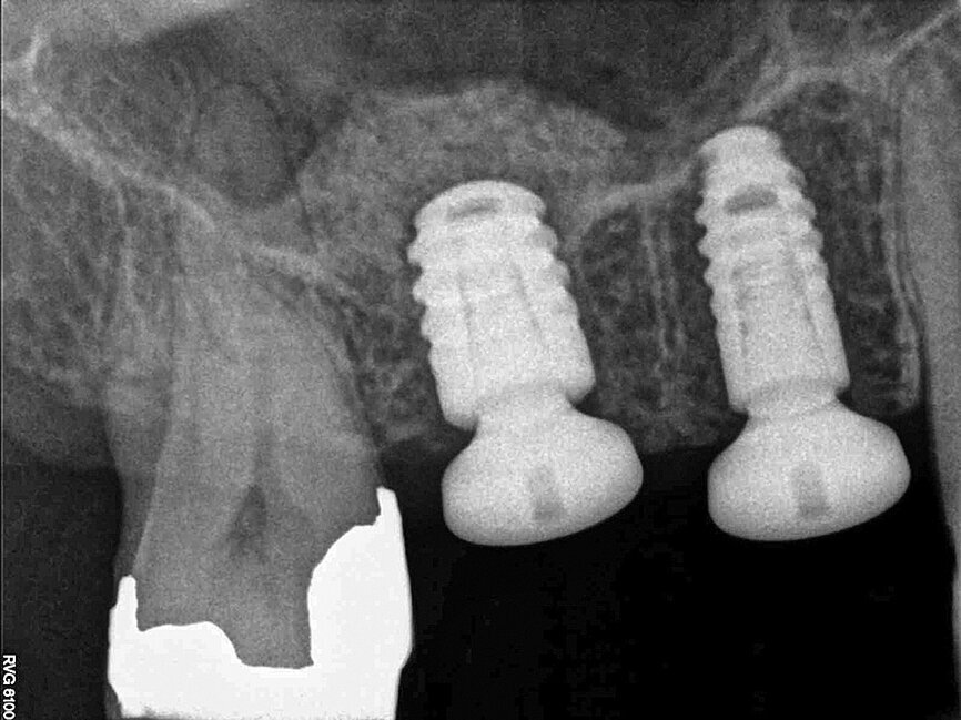 Fig. 19: Computer-guided navigation enabled the implants to be placed reliably and predictably within optimum bone, without the need to reflect a flap.