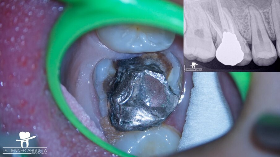 Fig. 1: Severely destroyed maxillary first molar with an old amalgam restoration, previous root canal therapy and recurrent caries.