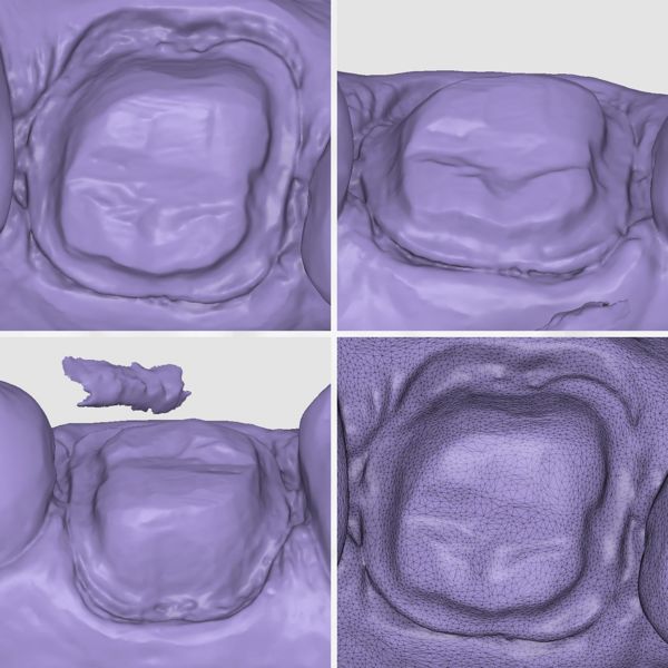 Fig. 8: Preparation margins on the Medit i900 scan.