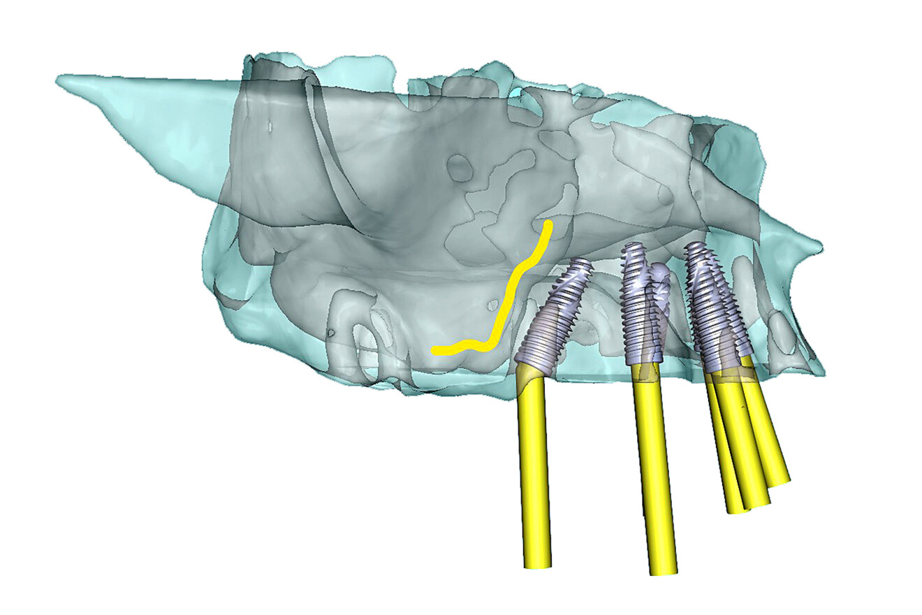 Fig. 3c: Selective transparency views of the simulated implants in the maxillary arch, including posterior tilted implants to avoid the maxillary sinus; right lateral view.