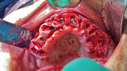 The use of autologous tooth structure as adjunct grafting modality for full-arch dental implant rehabilitation