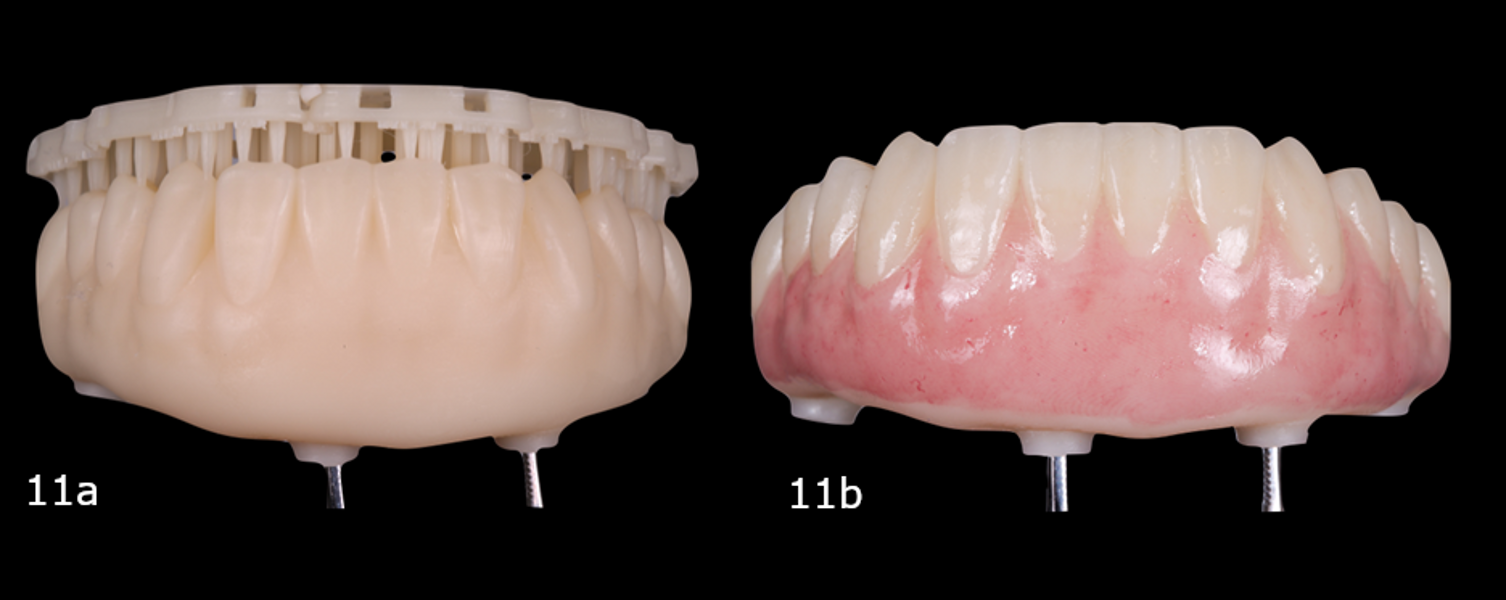 Figs. 11a & b: 3D-printed prosthesis before processing (a). Finished prosthesis after removal of the printing supports and final staining and glazing (b).