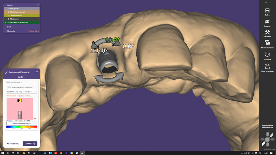 Figg. 2, 3_La scelta dello spazio cemento viene deciso in fase iniziale di accoppiamento della libreria con la scansione e rivalutabile all’interno del progetto CAD rientrando in “Expert Mode” e cambiando la libreria selezionata inizialmente. Medesima procedura si utilizza per la scelta dell’angolo del canale vite, scelto inizialmente e rivalutato durante l’avanzamento del progetto CAD.