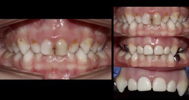 Caries severa de primera infancia en odontopediatría