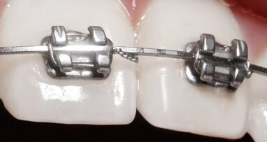 Digitální Flash-Free Bonding: další evoluční krok při nasazení zámků