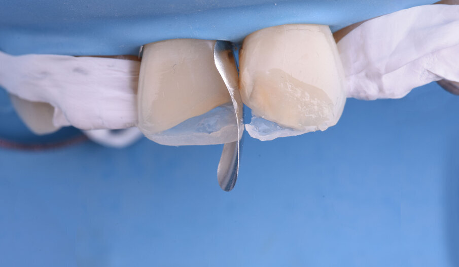 Sl. 9b: Modelovanje aproksimalnog zida restauracije