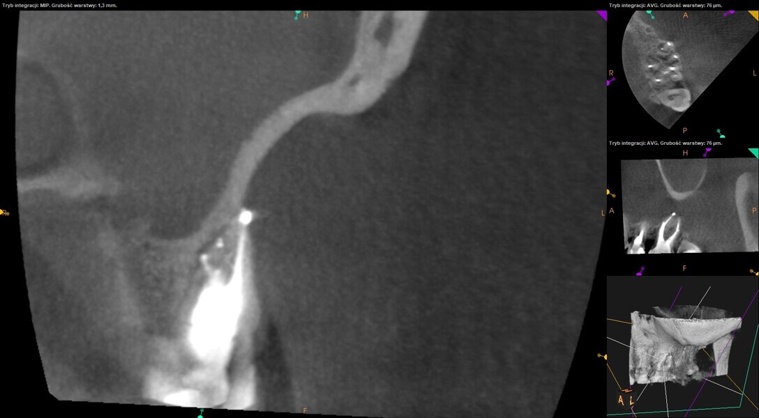 Fig. 25: Post-op CBCT image showing three portals of exit in the mesiobuccal root of the first molar.