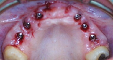 Planification prothétique rapide et facile