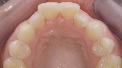 Inmam Aligner: Korigovanje položaja zuba, beljenje i izrada direktnih adhezivnih restauracija – progresivni pristup preoblikovanju izgleda osmeha (Drugi deo)