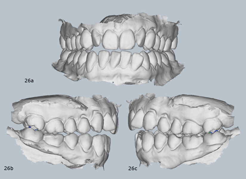 Figs. 26a–c: Virtual articulator showing occlusal changes after splint therapy.
