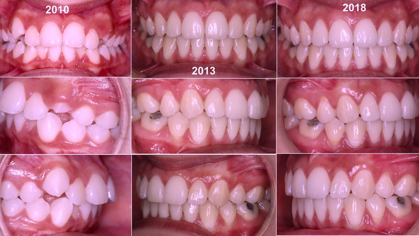 ¿Extracción o Expansión en Ortodoncia? (5)